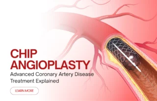 Chip angioplasty