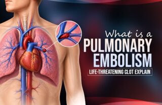 what is a pulmonary embolism