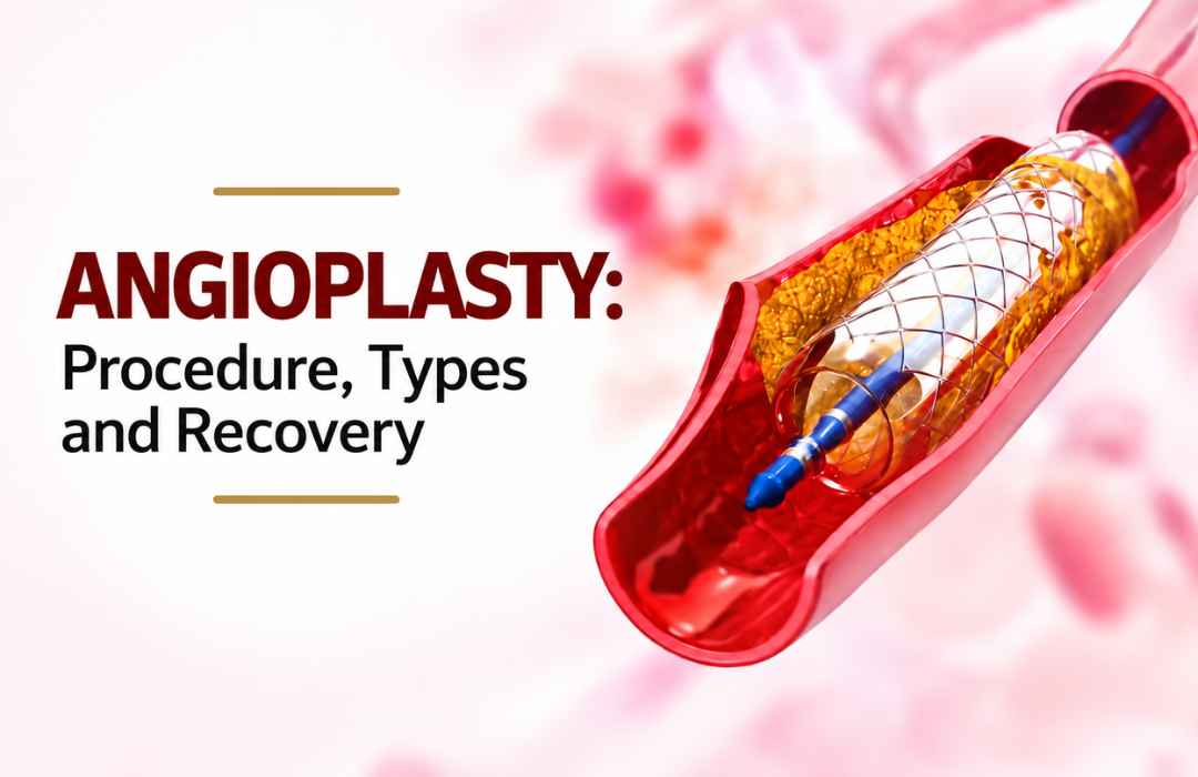 Angioplasty-Procedure-Types-and-Recovery.jpg