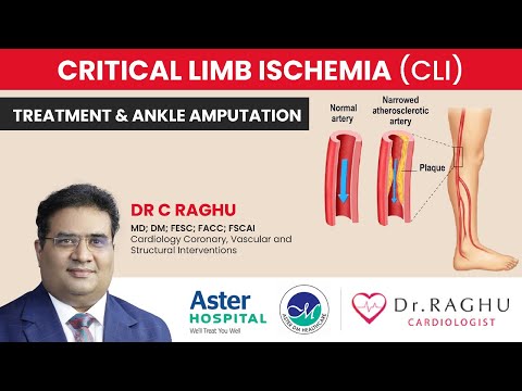 What causes ankle amputation | How to recover fast from amputation| Dr C Raghu| Cardiologist