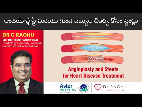 What is Angioplasty and Stents| What are the best treatments for heart attack| Aster prime hospital